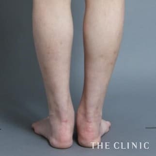 【THE CLINIC 症例画像】No.456_2_ふくらはぎ_1Day脂肪吸引(日帰りの脂肪吸引)