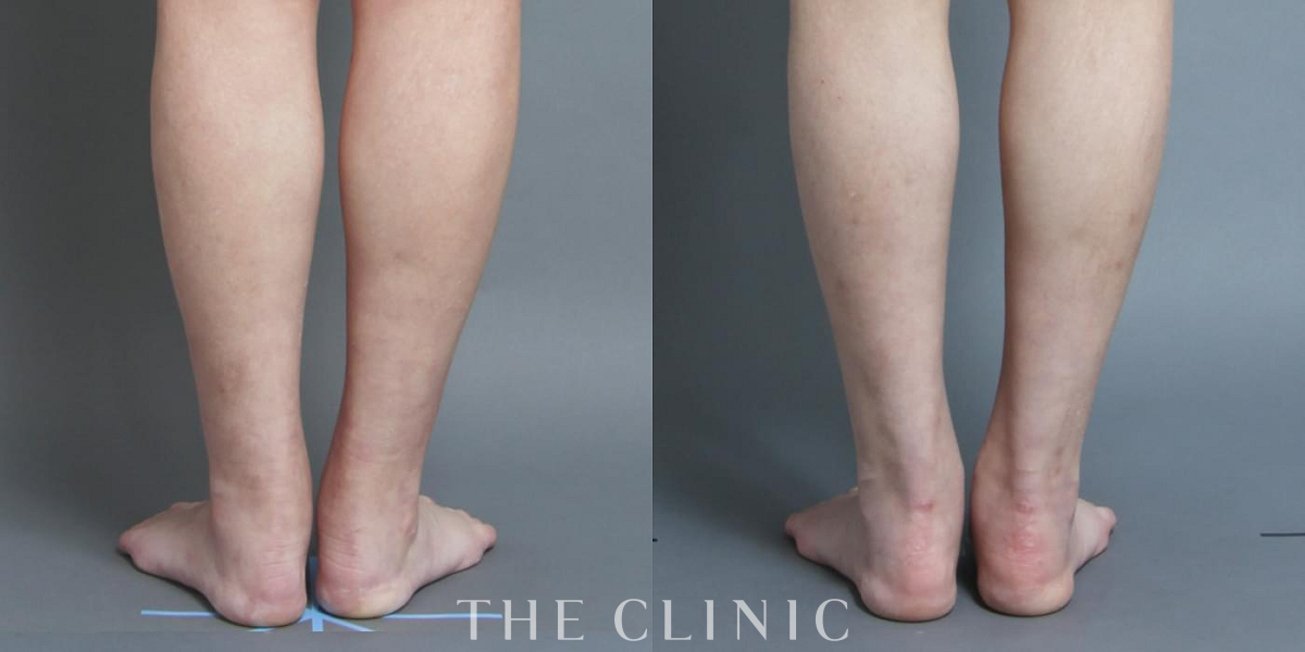 1Day脂肪吸引(日帰りの脂肪吸引)の術前／術後