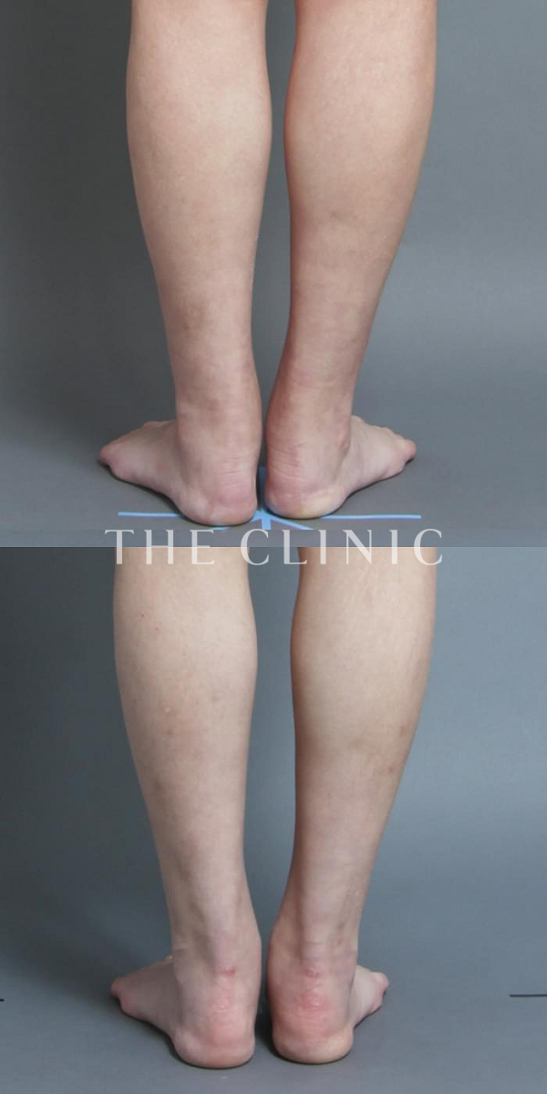 ふくらはぎの1Day脂肪吸引(日帰りの脂肪吸引)（28歳女性）の術前・術後写真