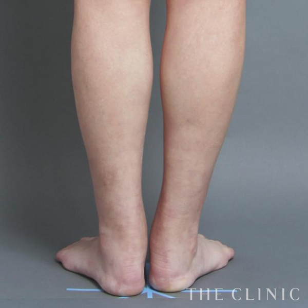 ふくらはぎの1Day脂肪吸引(日帰りの脂肪吸引)（28歳女性）の術前写真