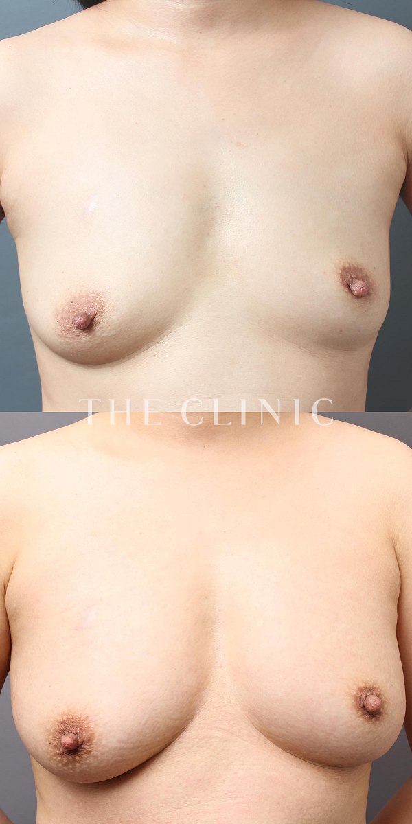 ボリュームアップのコンデンスリッチ豊胸（40歳女性）の術前・術後写真