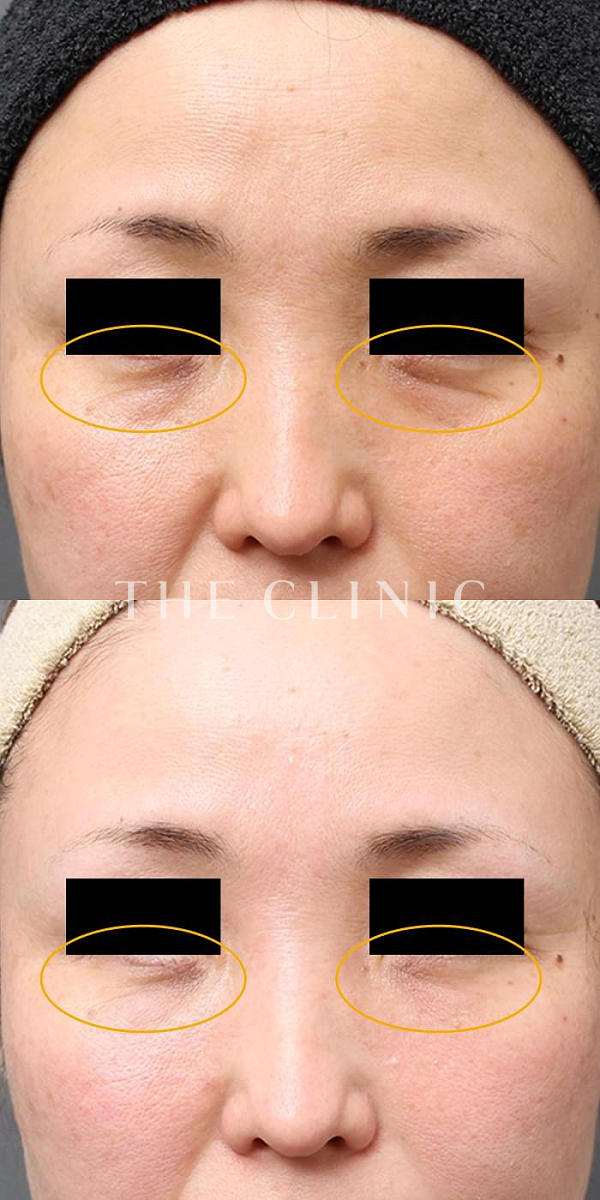 目の下のクマのマイクロCRF注入(顔の脂肪注入)（46歳女性）の術前・術後写真