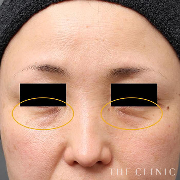 目の下のクマのマイクロCRF注入(顔の脂肪注入)（46歳女性）の術前写真