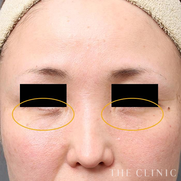 目の下のクマのマイクロCRF注入(顔の脂肪注入)（46歳女性）の術後写真