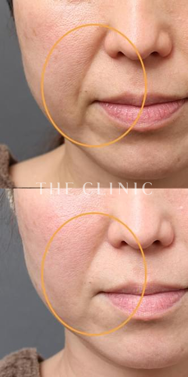 法令線・マリオネットラインのマイクロCRF注入(顔の脂肪注入)（46歳女性）の術前・術後写真