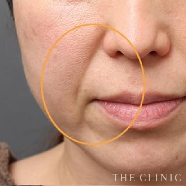 法令線・マリオネットラインのマイクロCRF注入(顔の脂肪注入)（46歳女性）の術前写真