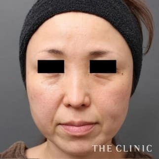【THE CLINIC 症例画像】No.465_1_目の下のクマ_マイクロCRF注入(顔の脂肪注入)(執刀医:村田 八千穂)