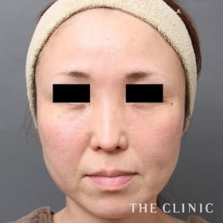 【THE CLINIC 症例画像】No.465_2_目の下のクマ_マイクロCRF注入(顔の脂肪注入)(執刀医:村田 八千穂)