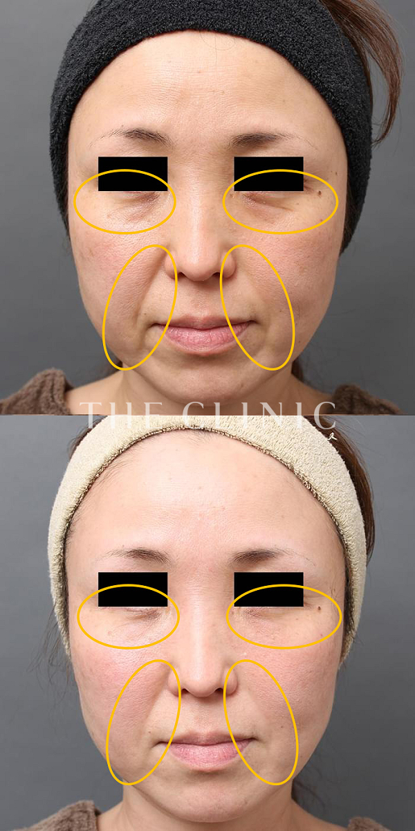 目の下のクマ・法令線のマイクロCRF注入(顔の脂肪注入)（46歳女性）の術前・術後写真