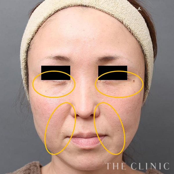 目の下のクマ・法令線のマイクロCRF注入(顔の脂肪注入)（46歳女性）の術後写真