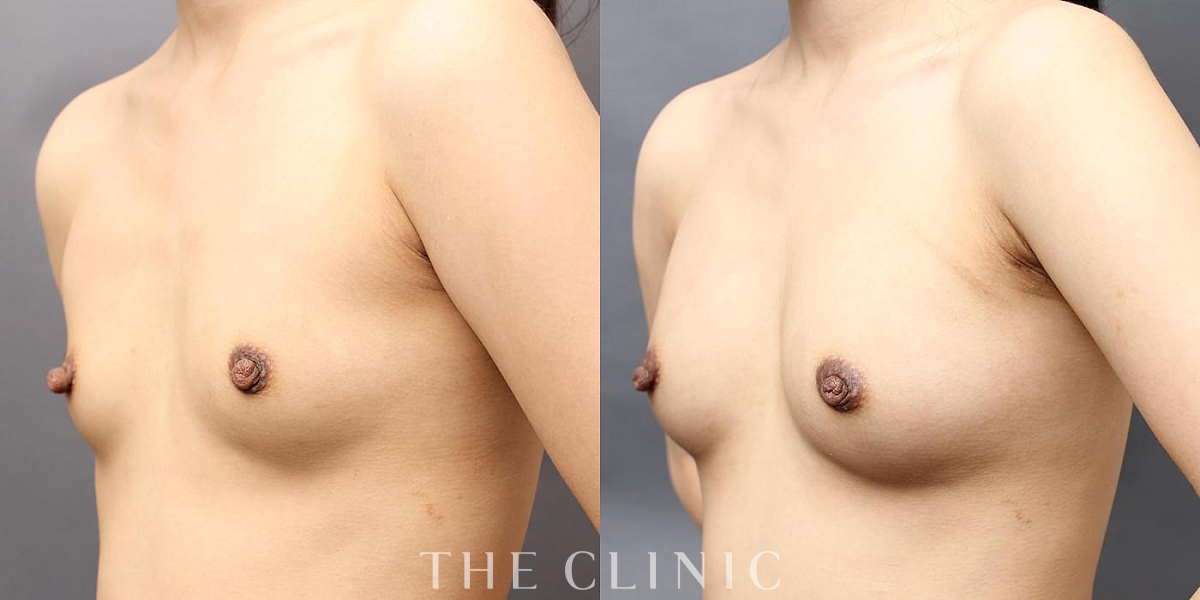 BRAVA×コンデンスリッチ豊胸の術前／術後