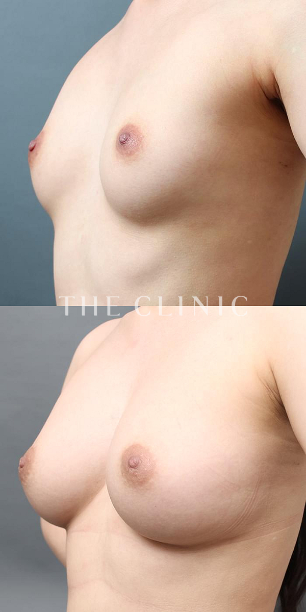 ボリュームアップのコンデンスリッチ豊胸（29歳女性）の術前・術後写真