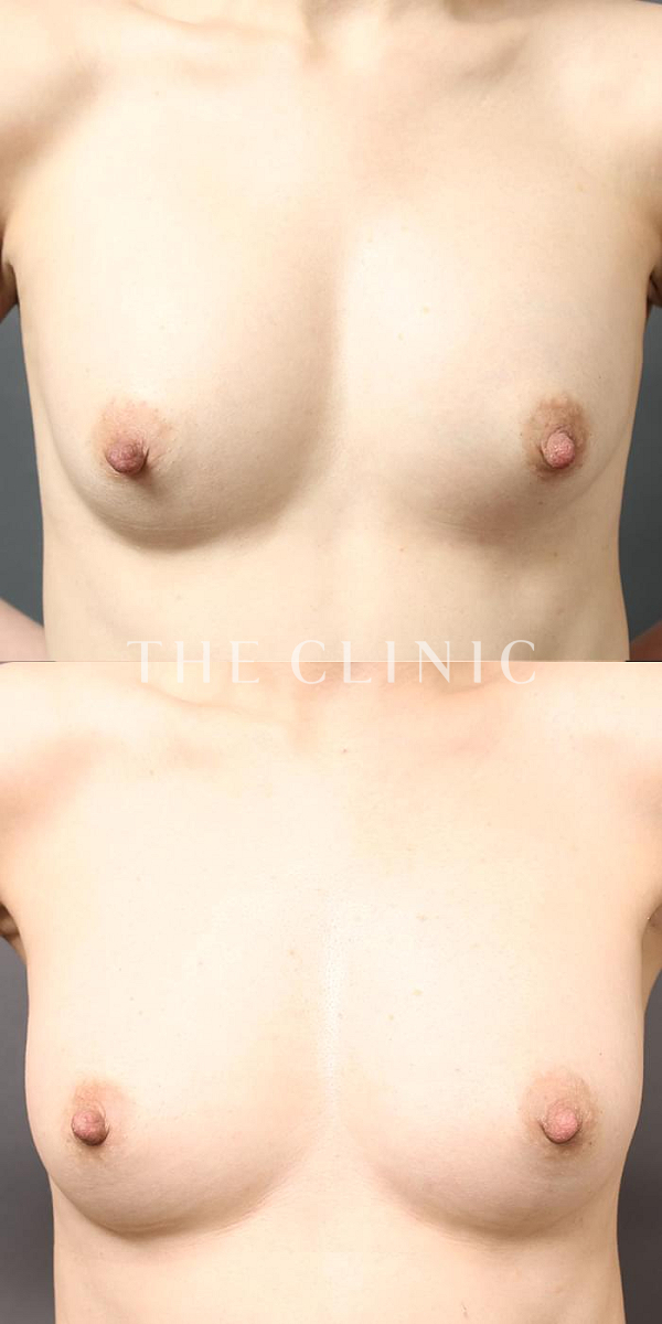 シリコンバッグ抜去の豊胸シリコンバッグ除去（40歳女性）の術前・術後写真