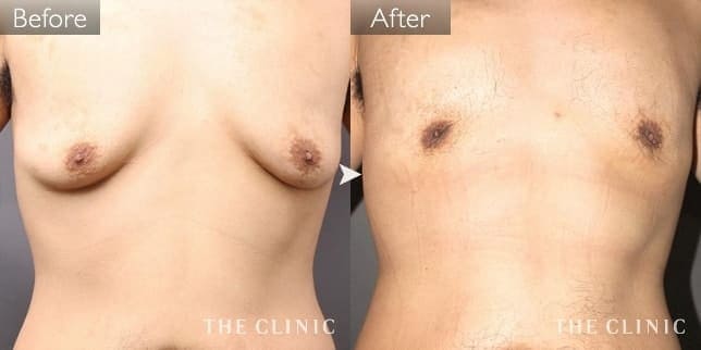 女性化乳房(男性/37歳)