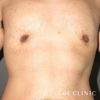 女性化乳房／真性＋偽性女性化乳房の女性化乳房治療(男性の胸の膨らみ改善)のモニター（30代）術後症例画像