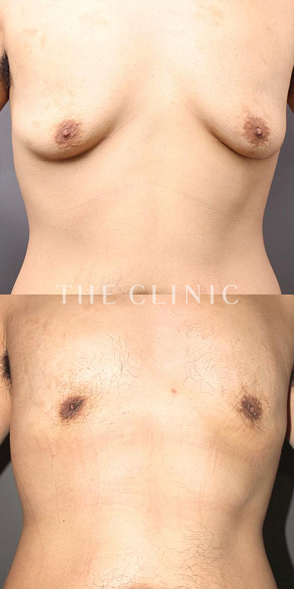 女性化乳房・真性＋偽性女性化乳房の女性化乳房治療(男性の胸の膨らみ改善)（37歳男性）の術前・術後写真