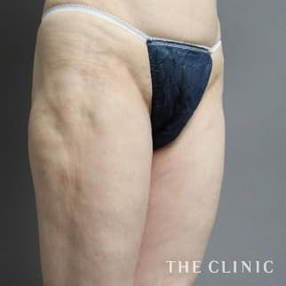 【THE CLINIC 症例画像】No.475_1_太もも_他院の脂肪吸引修正(執刀医：大橋 昌敬)