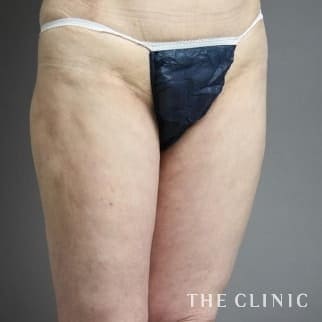 【THE CLINIC 症例画像】No.475_2_太もも_他院の脂肪吸引修正(執刀医:大橋 昌敬)