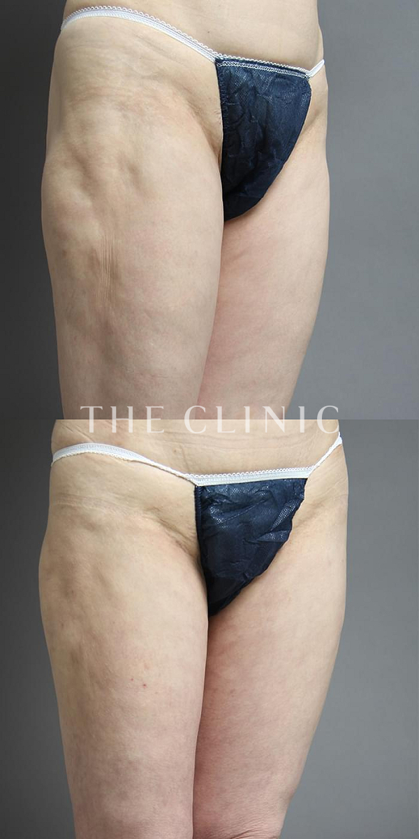 太ももの他院の脂肪吸引修正（50歳女性）の術前・術後写真