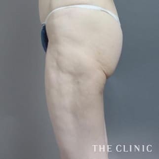 【THE CLINIC 症例画像】No.476_1_太もも_他院の脂肪吸引修正(執刀医：大橋 昌敬)