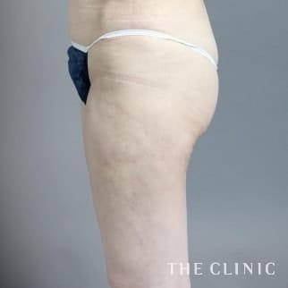 【THE CLINIC 症例画像】No.476_2_太もも_他院の脂肪吸引修正(執刀医:大橋 昌敬)
