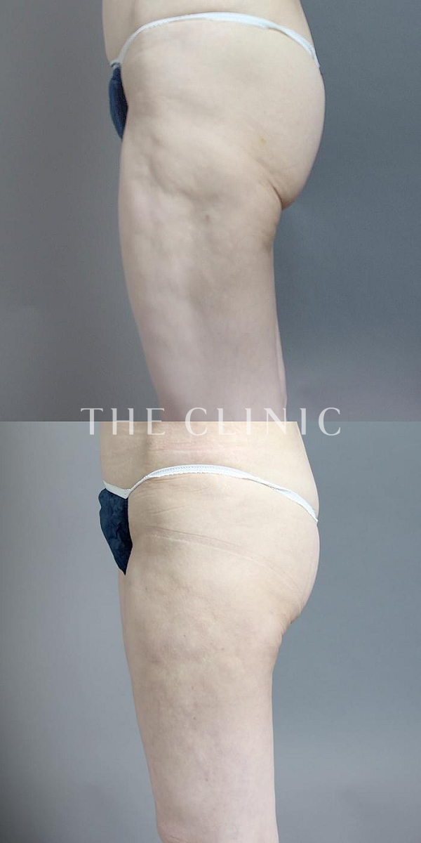 太ももの他院の脂肪吸引修正（50歳女性）の術前・術後写真
