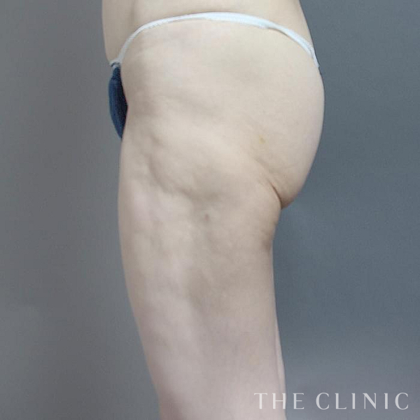 太ももの他院の脂肪吸引修正（50歳女性）の術前写真