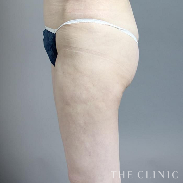 太ももの他院の脂肪吸引修正（50歳女性）の術後写真