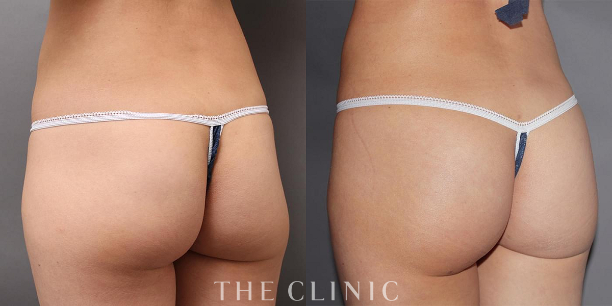 ヒップメイク by 360脂肪吸引®の術前／術後