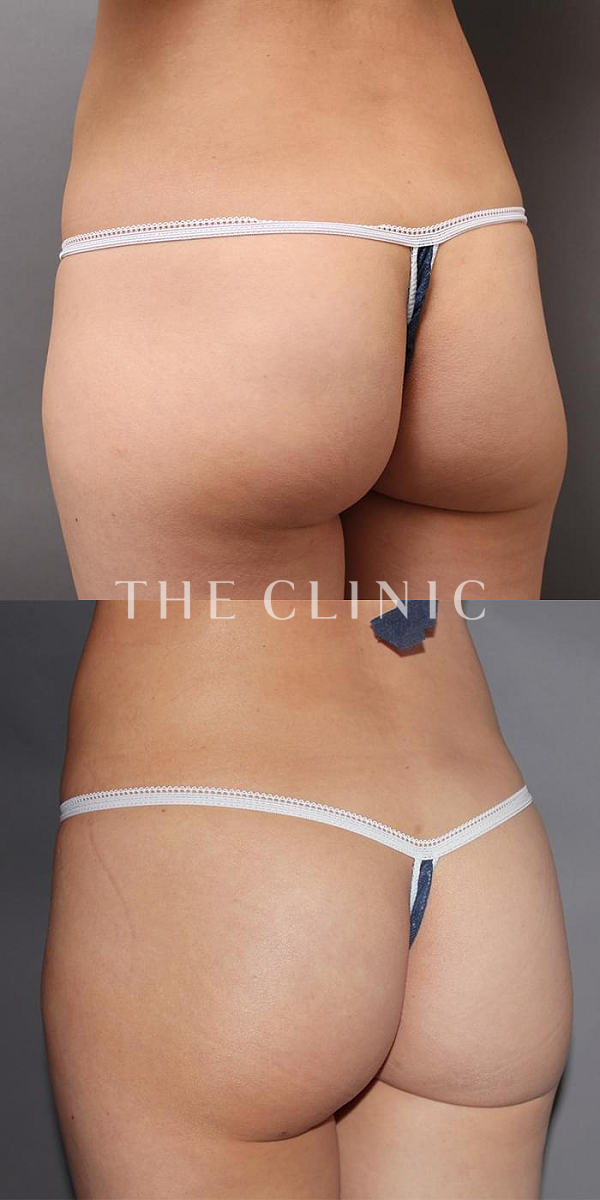 お尻・ボリュームアップのヒップメイク by 360脂肪吸引®（31歳女性）の術前・術後写真