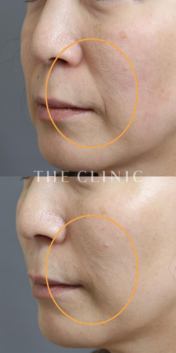 法令線のマイクロCRF注入(顔の脂肪注入)（47歳女性）の術前・術後写真