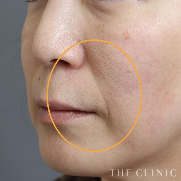 法令線のマイクロCRF注入(顔の脂肪注入)（47歳女性）の術前写真