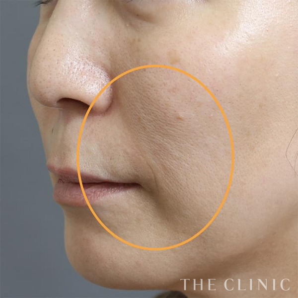 法令線のマイクロCRF注入(顔の脂肪注入)（47歳女性）の術後写真