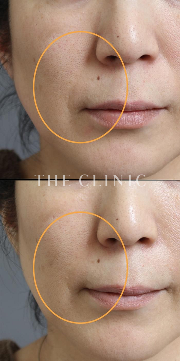 法令線のマイクロCRF注入(顔の脂肪注入)（47歳女性）の術前・術後写真