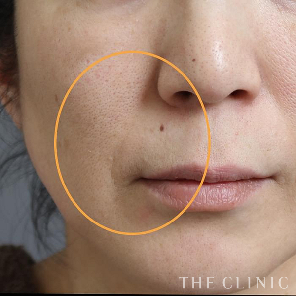 法令線のマイクロCRF注入(顔の脂肪注入)（47歳女性）の術前写真