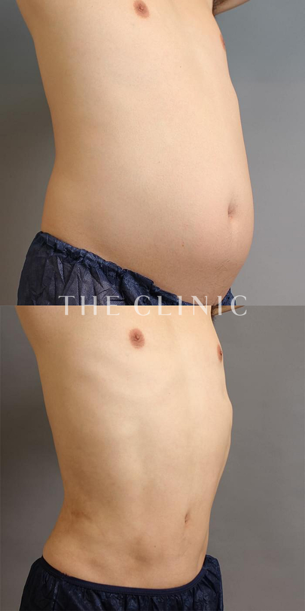 腹部のベイザー脂肪吸引（39歳男性）の術前・術後写真