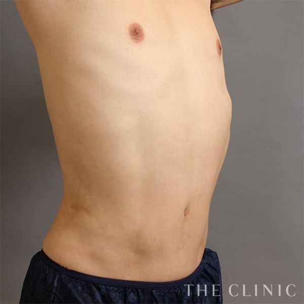 腹部のベイザー脂肪吸引（39歳男性）の術後写真