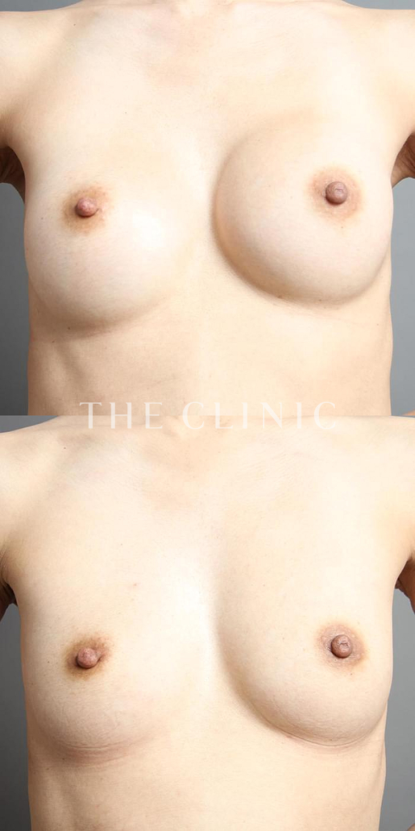 不自然な形の豊胸シリコンバッグ除去（38歳女性）の術前・術後写真