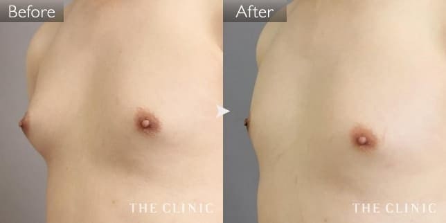 真性女性化乳房（男性／31歳）