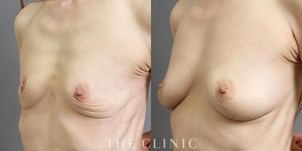 コンデンスリッチ豊胸の術前/術後