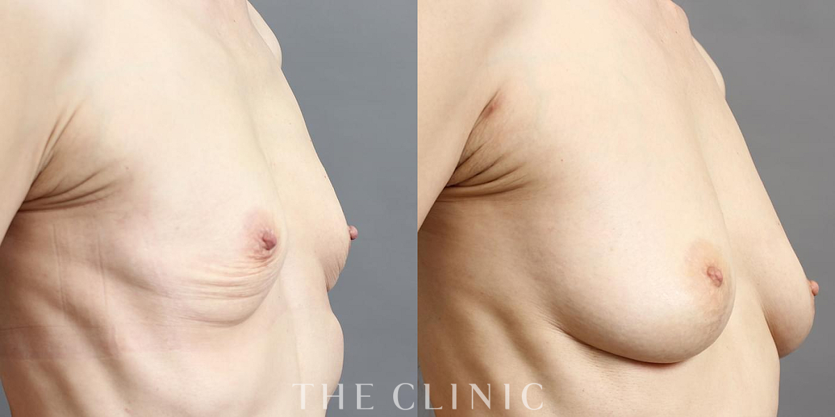 コンデンスリッチ豊胸の術前/術後