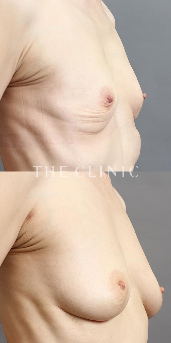 授乳後のたるみのコンデンスリッチ豊胸（52歳女性）の術前・術後写真