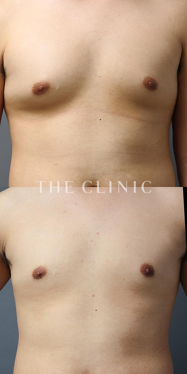 女性化乳房・偽性女性化乳房の女性化乳房治療(男性の胸の膨らみ改善)（23歳男性）の術前・術後写真