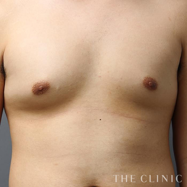 女性化乳房・偽性女性化乳房の女性化乳房治療(男性の胸の膨らみ改善)（23歳男性）の術前写真