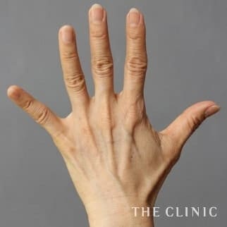 【THE CLINIC 症例画像】No.491_1_手のシワ_手の甲への脂肪注入(ハンドリバイブ)(執刀医:)