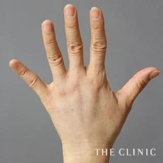 【THE CLINIC 症例画像】No.491_2_手のシワ_手の甲への脂肪注入(ハンドリバイブ)(執刀医:)