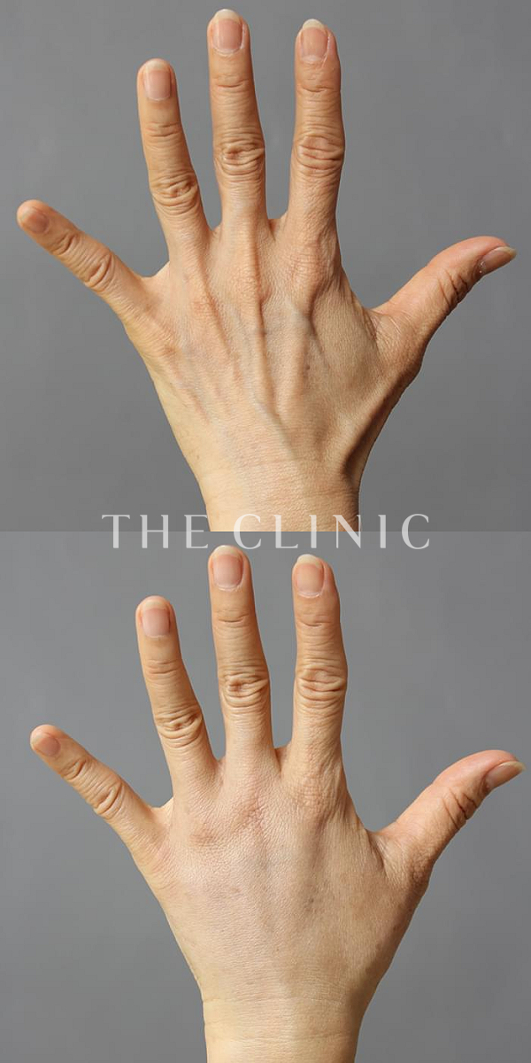 手のシワの手の甲への脂肪注入(ハンドリバイブ)（59歳女性）の術前・術後写真