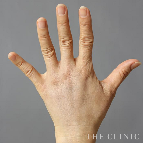 手のシワの手の甲への脂肪注入(ハンドリバイブ)（59歳女性）の術後写真