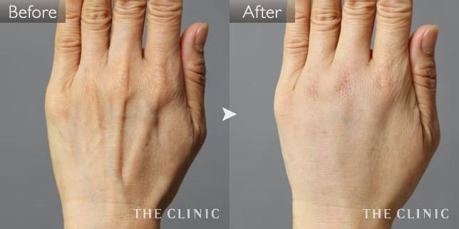 手のシワの手（女性／59歳）