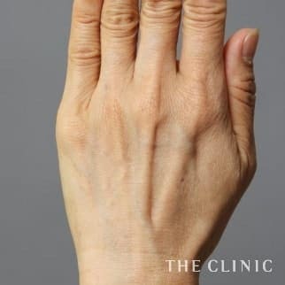 【THE CLINIC 症例画像】No.492_1_手のシワ_手の甲への脂肪注入(ハンドリバイブ)